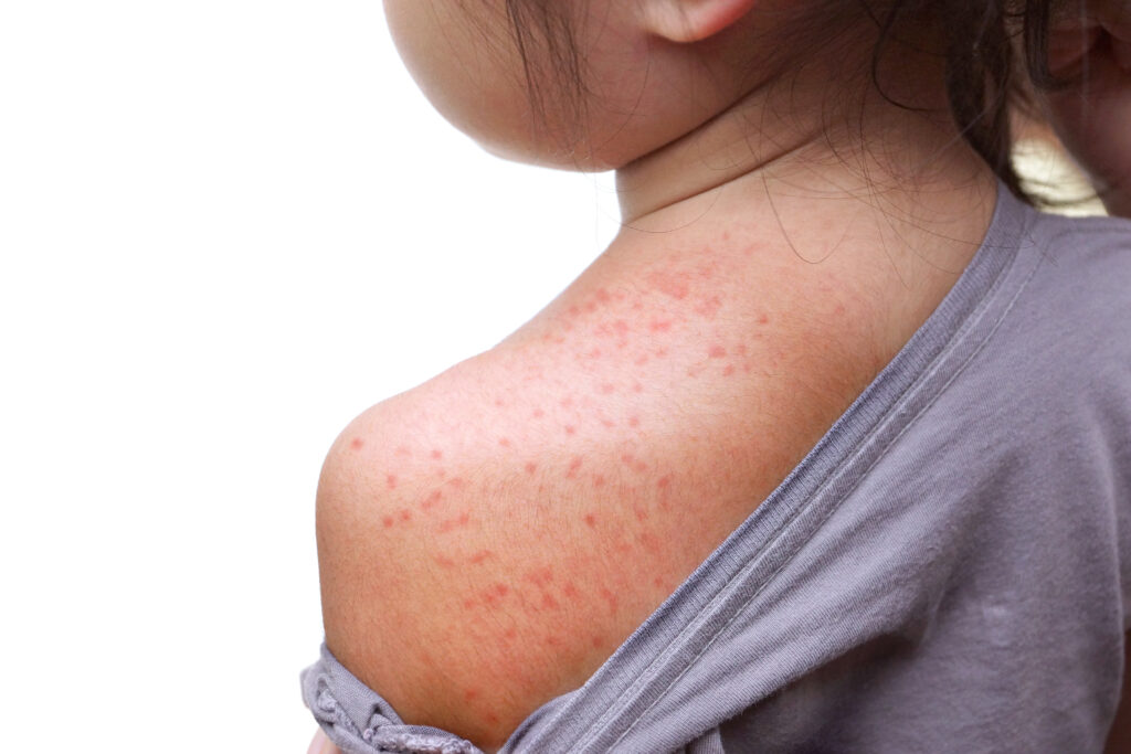 Measles on child